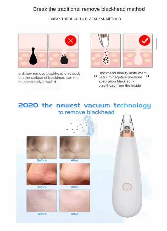 Blackhead Removal Machine – Advanced Pore Cleaning Tool for Smooth Skin